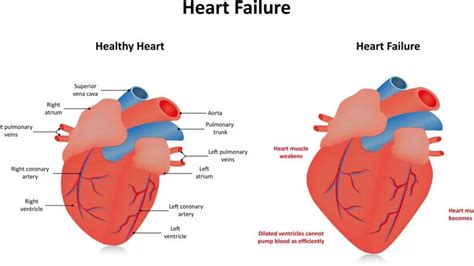 lv apex|severe hypokinesis of the apex.